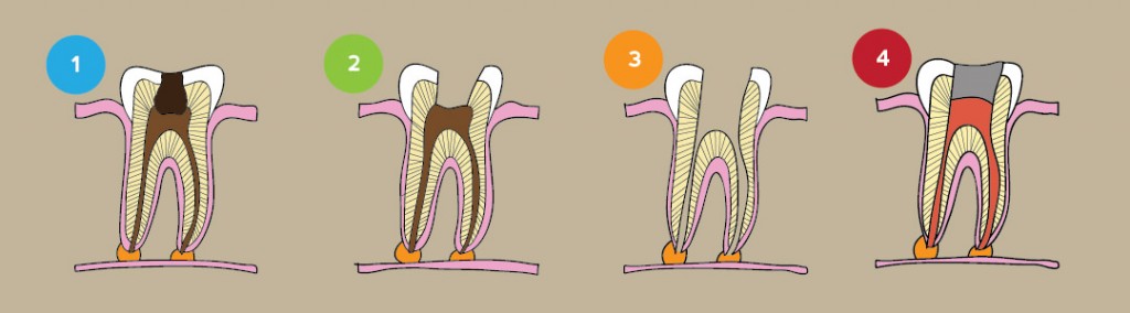 rootcanal